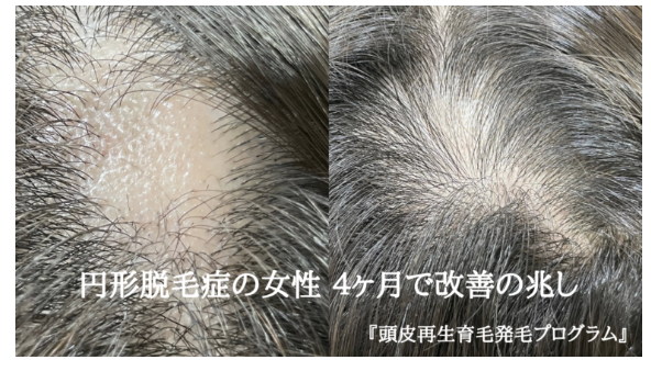 発毛実績