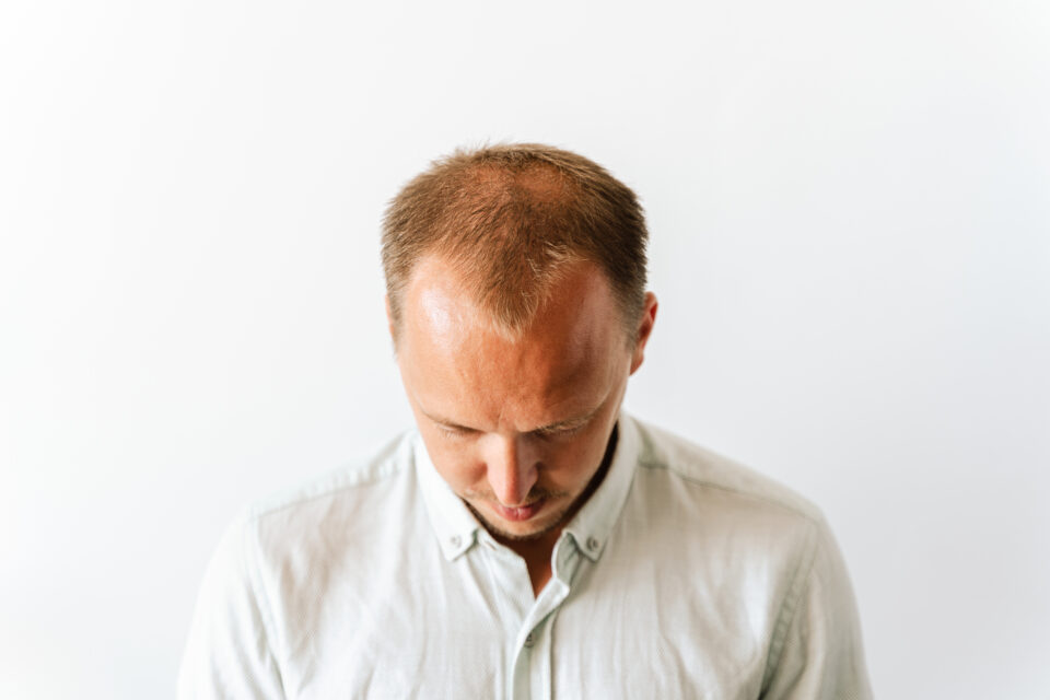 Before hair transplantation Young bald man with hair loss problems White background with copy space - 薄毛カット専門理容室(床屋)・美容室ポータル|USUGE BEAUTY