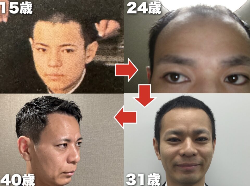 10代からAGAに悩み、20代の時にAGA治療、30代で自毛植毛に出会い、自分の髪の毛を取り戻したオーナーだからこそ、薄毛の悩みに対しての深い知識と経験をあわせ持ち、真摯に向き合ってくれます。。