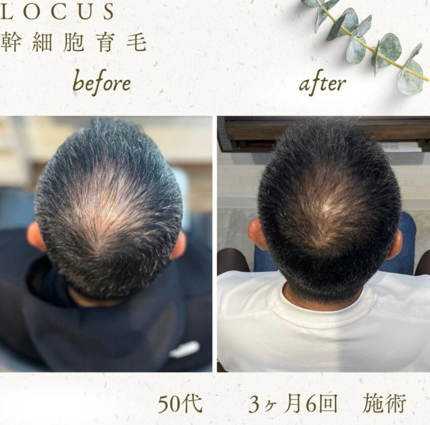 AGAによる薄毛のお悩みに対し、最新技術「ミコステラ」による施術を導入。  針を使わないエアインジェクションで幹細胞由来成分を頭皮深部まで届け、毛根環境を改善します。  その結果、発毛力が高まり、3ヶ月・6回の施術で目に見える変化を実感いただけました。