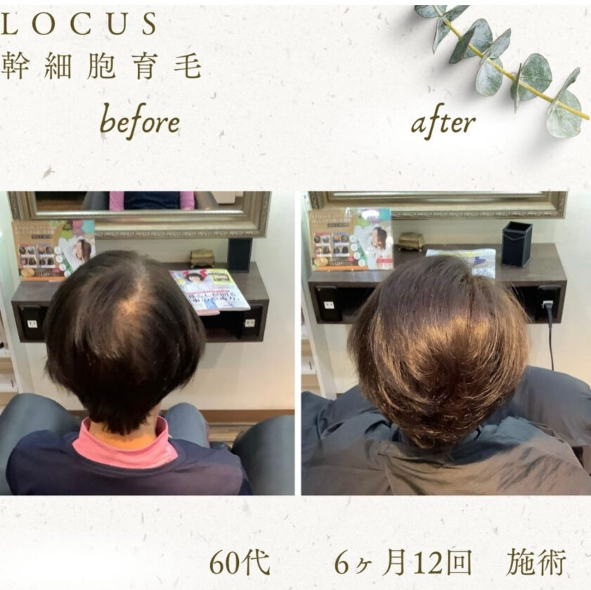 FAGA（女性型脱毛症）は、加齢やホルモンバランスの変化により毛包の活性が低下し、髪のボリューム減少を引き起こします。  「ミコステラ」は針を用いずに幹細胞由来成分を頭皮深部へ導入する最新技術で、毛根環境を整え発毛シグナルを活性化。  6ヶ月・12回の施術により、毛量・毛質の改善と共に自然なボリュームアップを実現しました。